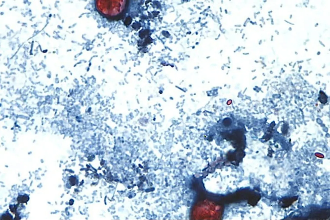 US Cyclosporiasis Cases Surpass 24,000 As Outbreak Slows