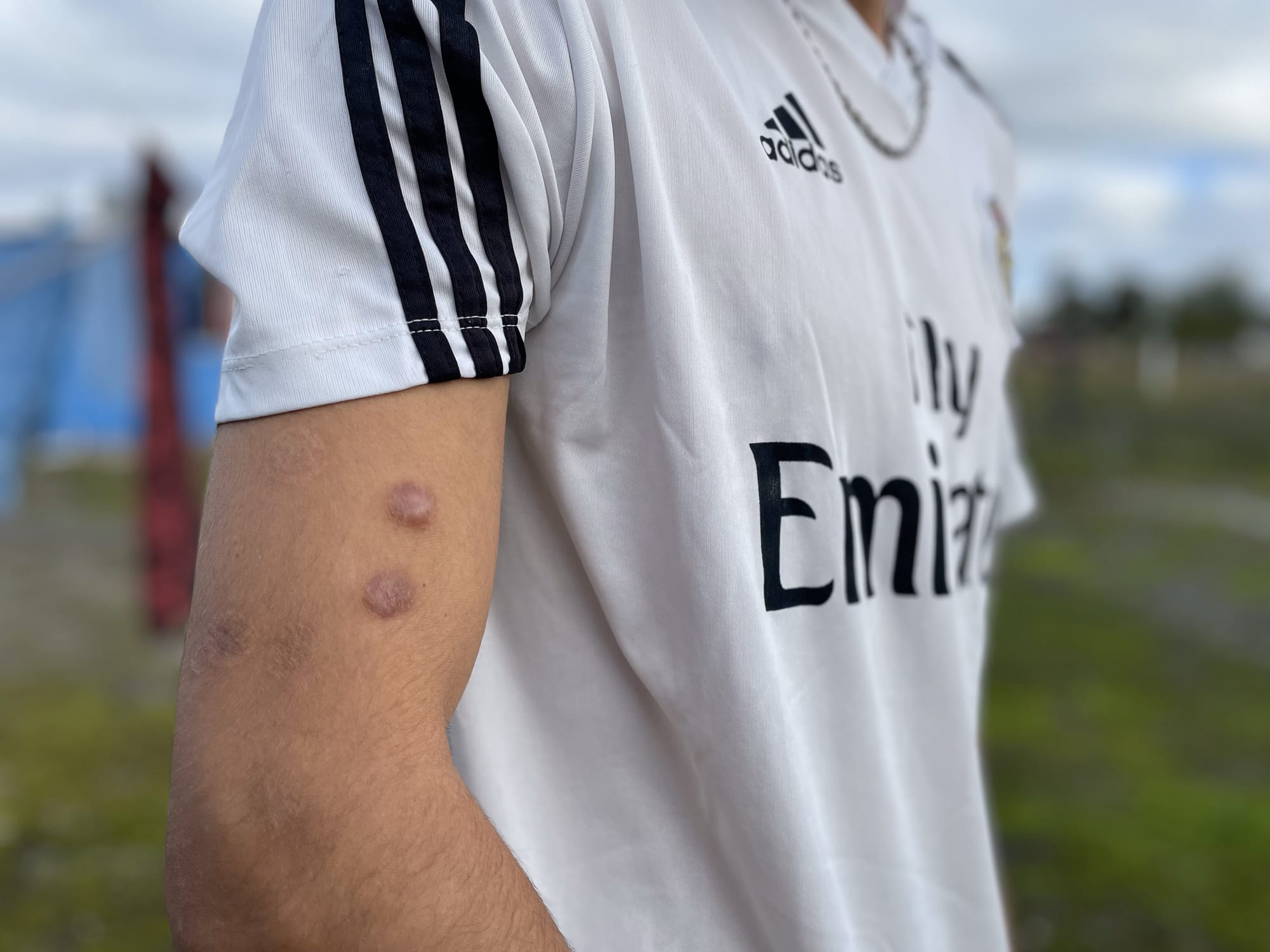 Sebastián Silva’s right arm, showing some of the 31 scars from rubber bullets fired by the police