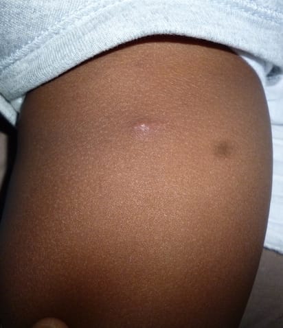 Child's leg with bug bite