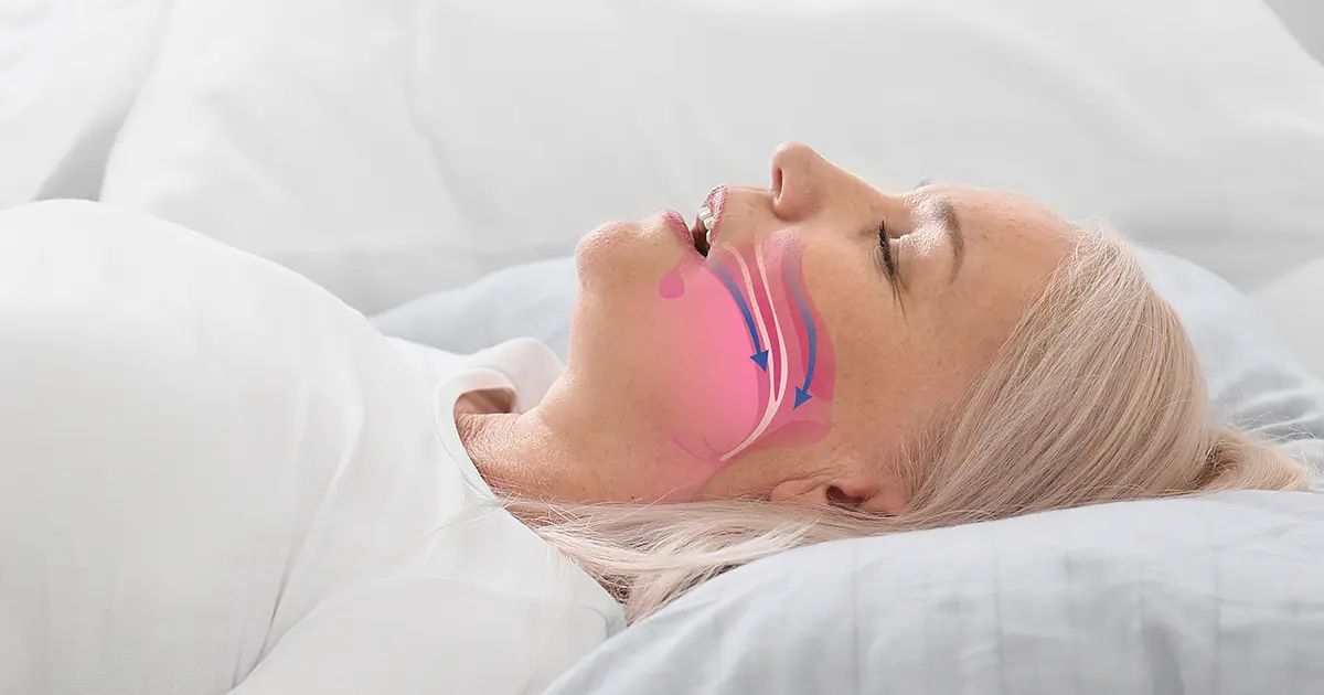 L'apnea notturna aumenta il rischio di demenza nelle donne anziane