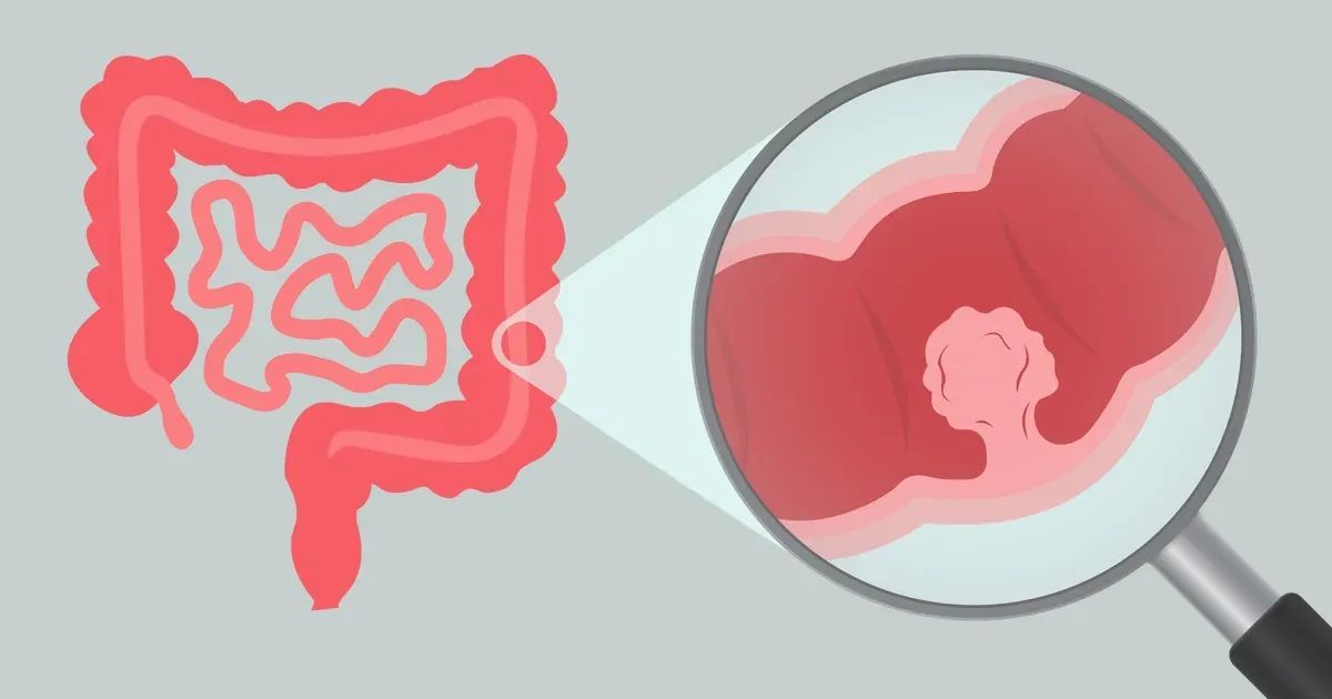 Sintomi dei polipi del colon a cui fare attenzione