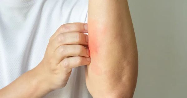 Sole e spezie sono tutto ciò che serve per curare la psoriasi