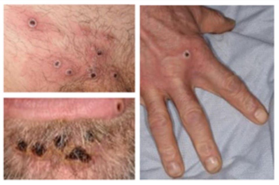Lesions caused by the monkeypox virus