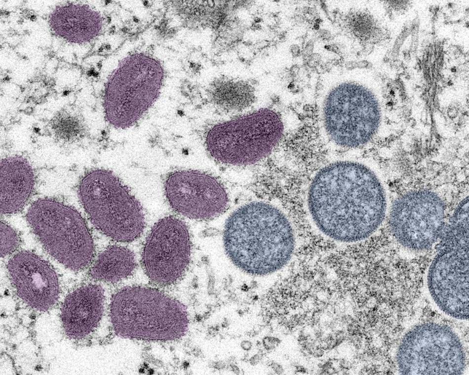 A digitally-colorized electron microscope image shows monkeypox virions