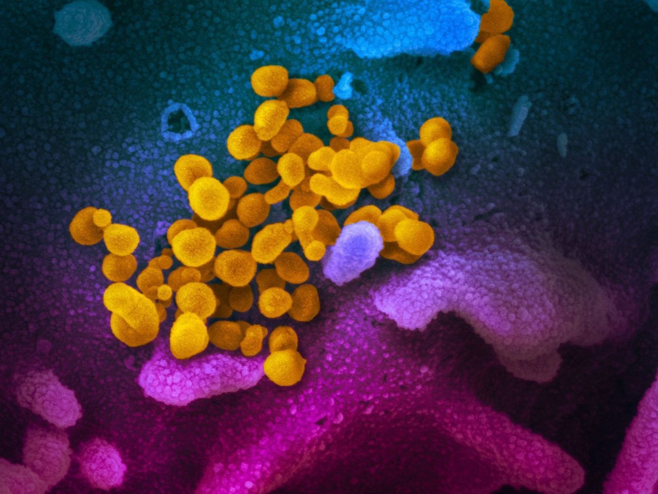 An electron microscope image of 2019-nCoV, in yellow, the virus that causes COVID-19