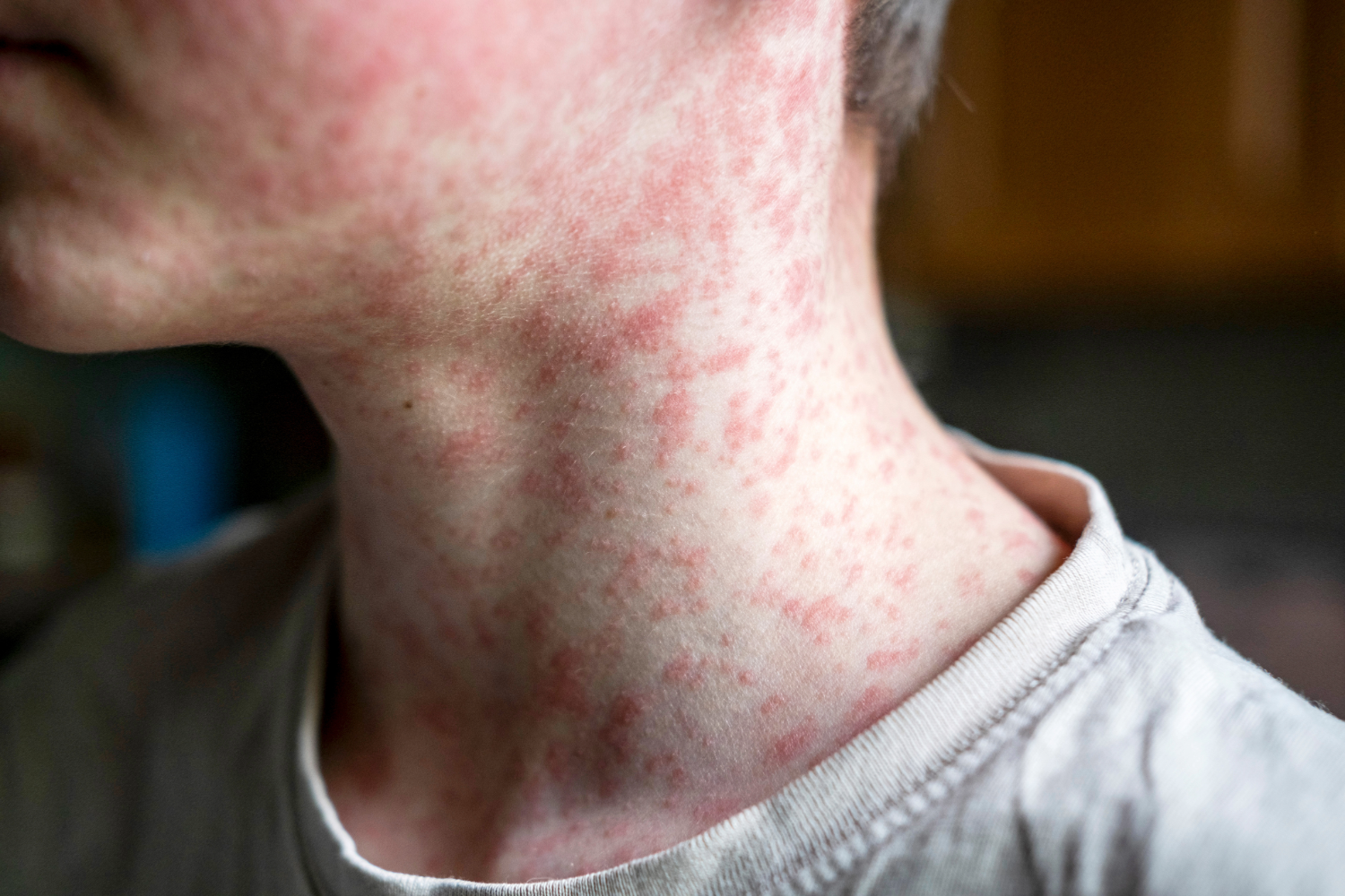 Festival Crowds Are Gone, Now Comes the Measles Watch