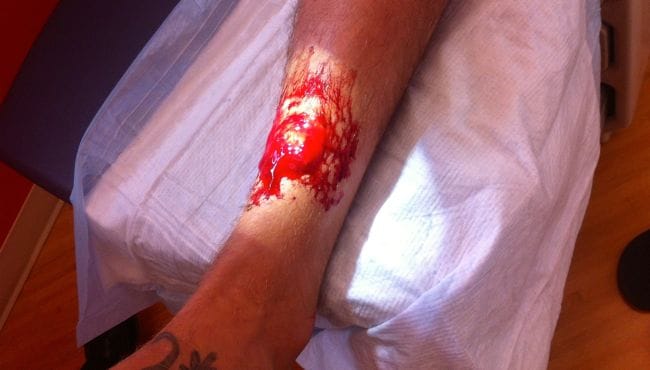 injury1
