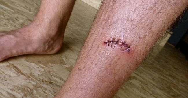 injury3
