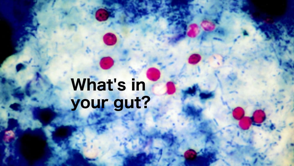 CDC Tracks Cyclospora Outbreak Across 17 States, 145 Cases Confirmed