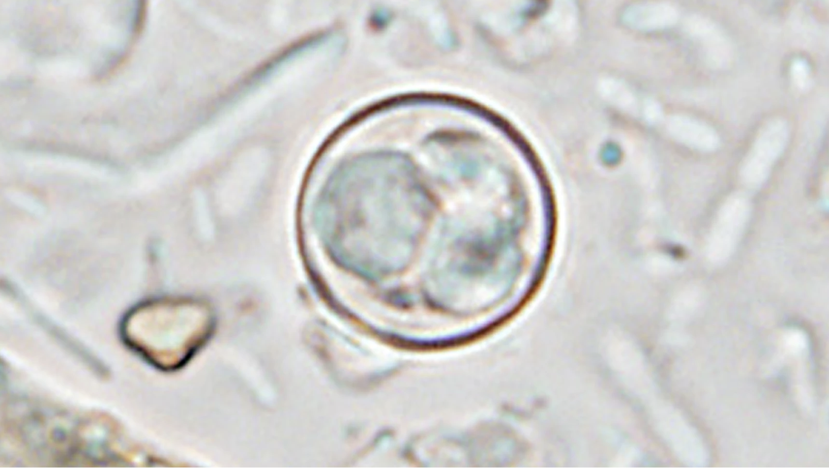 CDC's Aug. 18 weekly update raises the combined national Cyclospora tally to 27,557 cases.