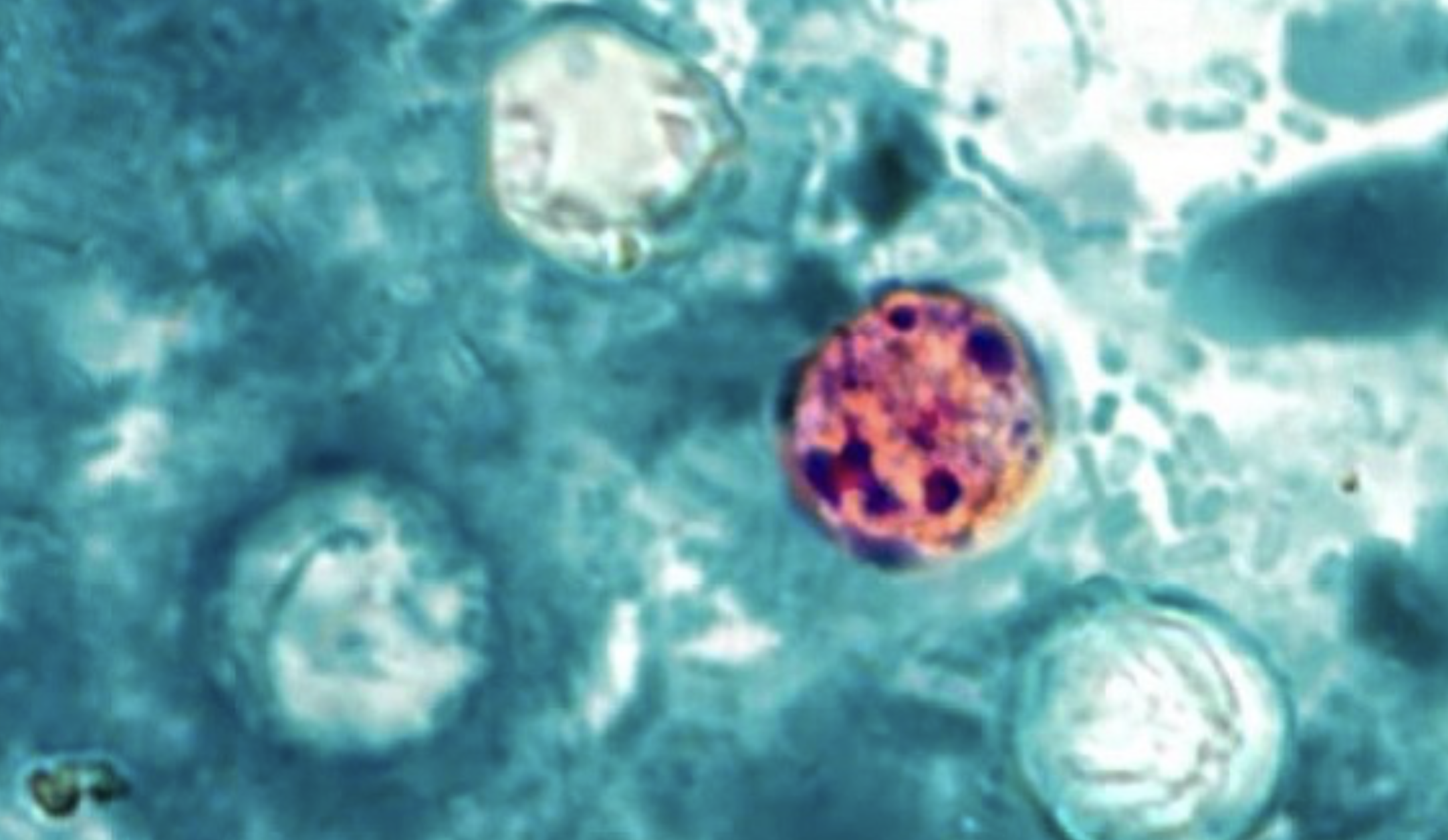 Michigan's cyclosporiasis case count reaches 14,718 as of Sept 3, 2026.