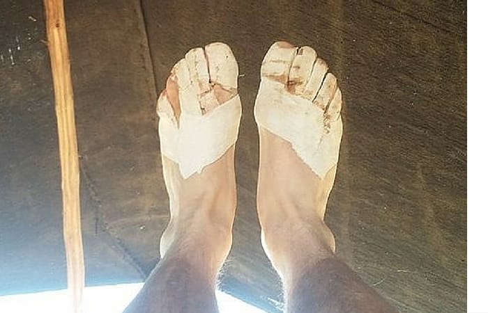 Feet of endurance - Lee's heavily plastered, blistered feet during the run