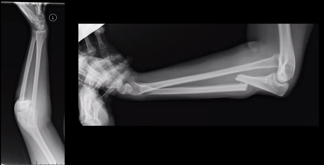 Monteggia Fracture ORIF