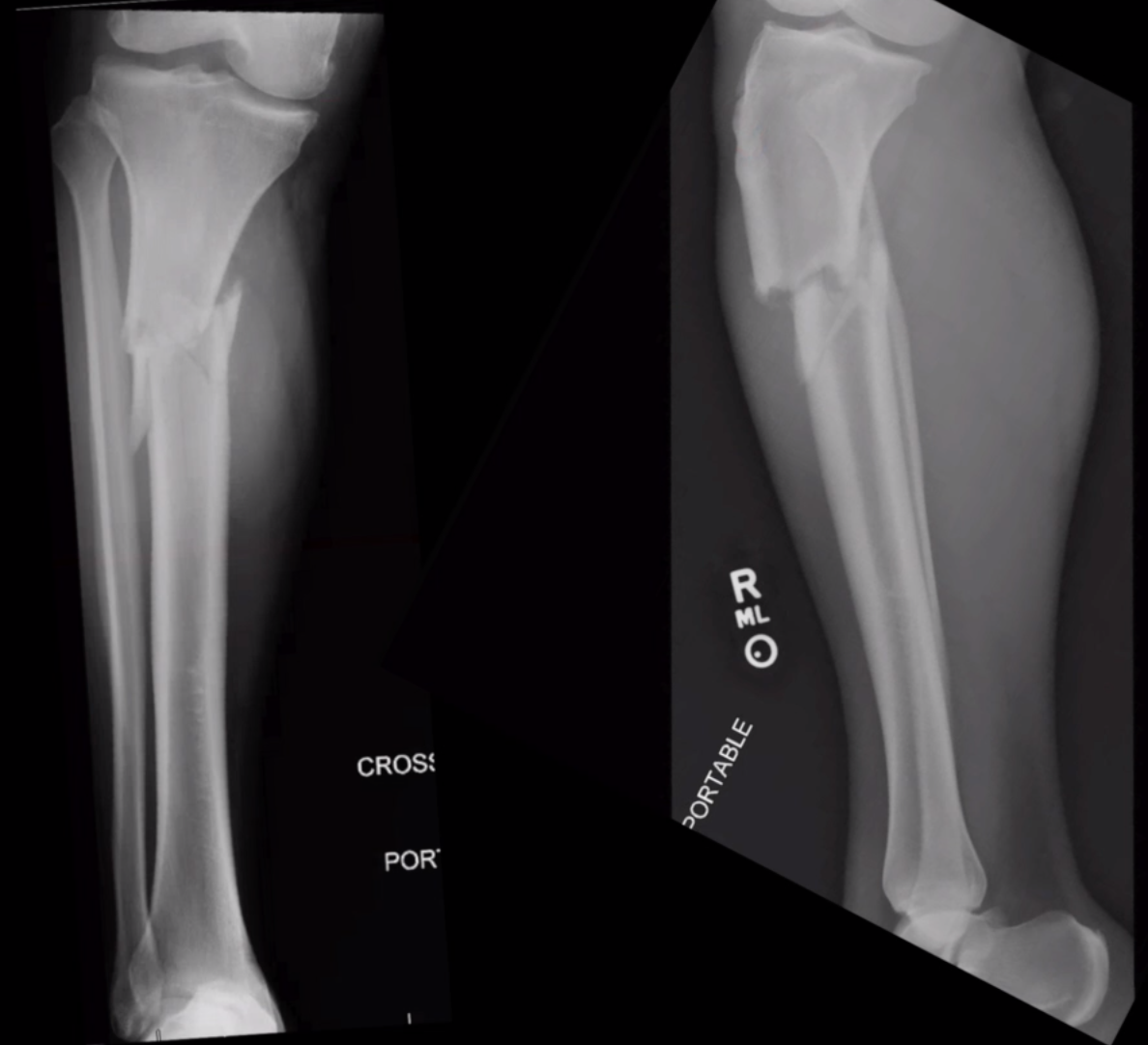 Proximal Tibia IMN