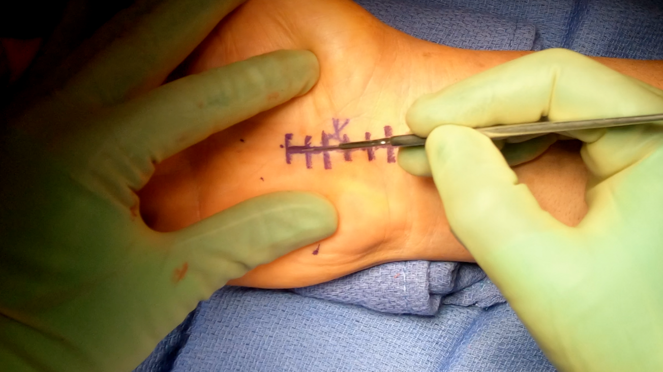 Carpal Tunnel Release