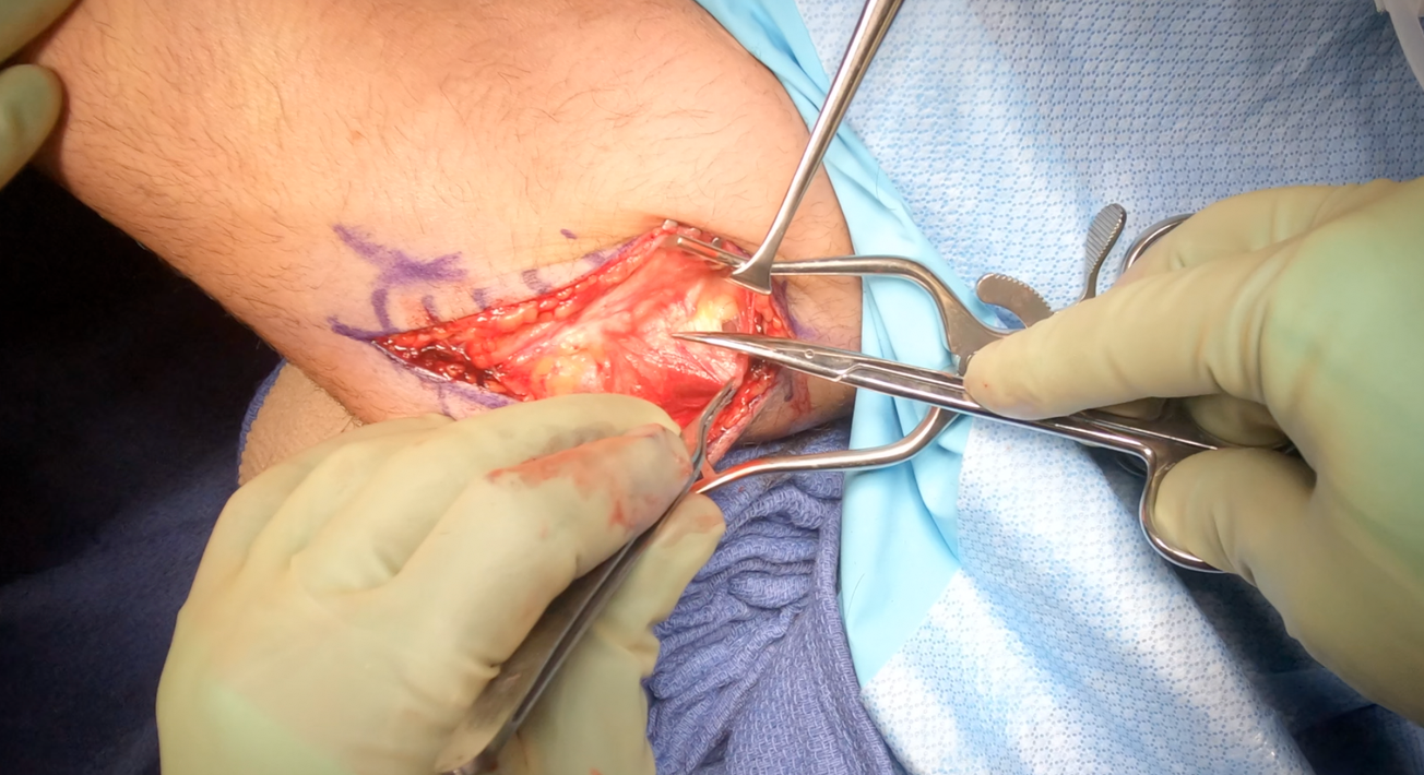 Cubital Tunnel Release