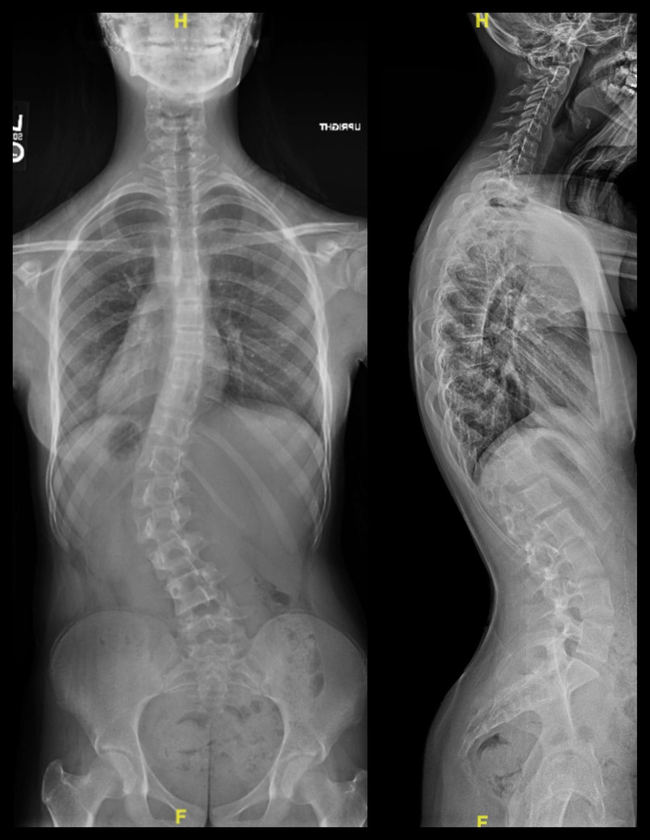 Posterior Spinal Fusion for Scoliosis