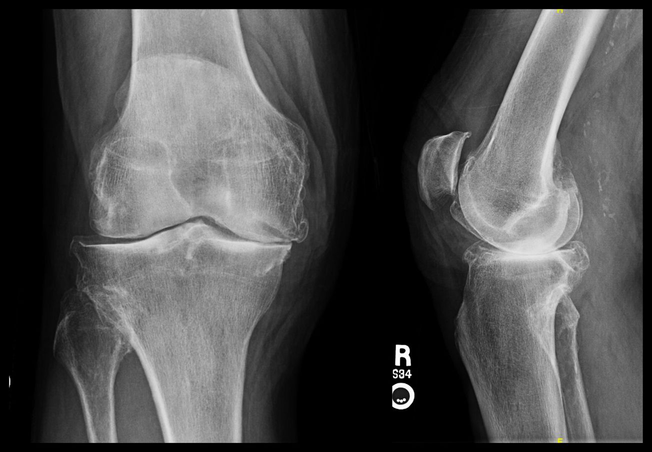 Total Knee Arthroplasty