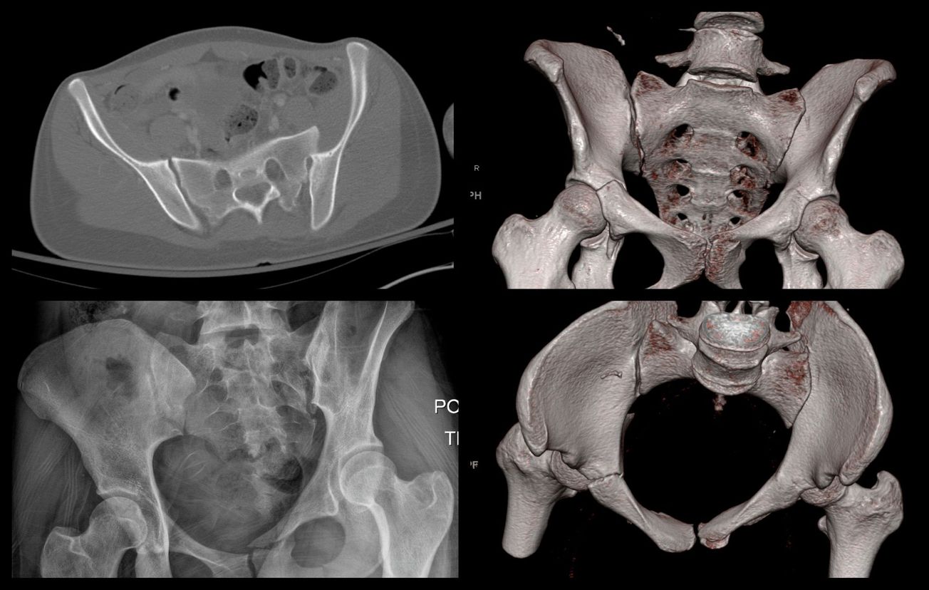 Posterior Sacroiliac Joint Fixation