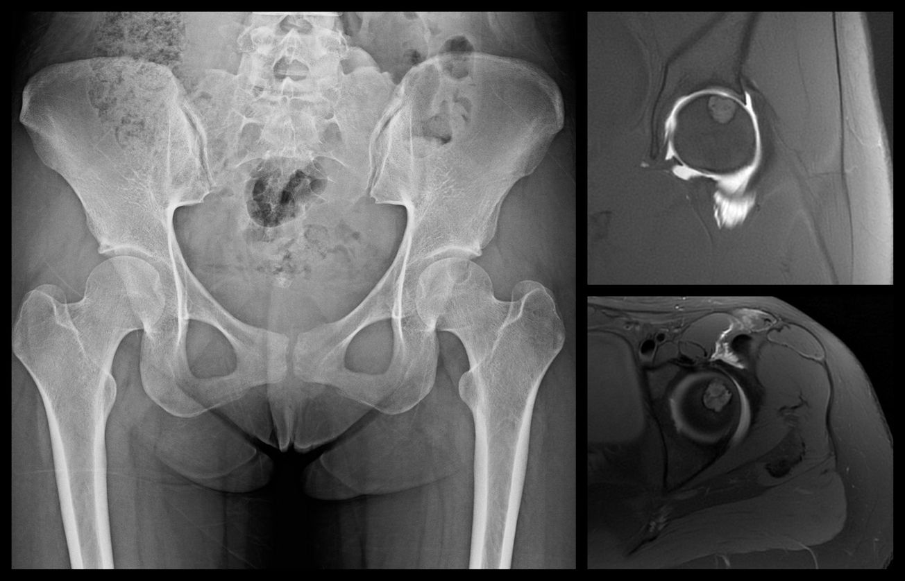 Surgical Hip Dislocation