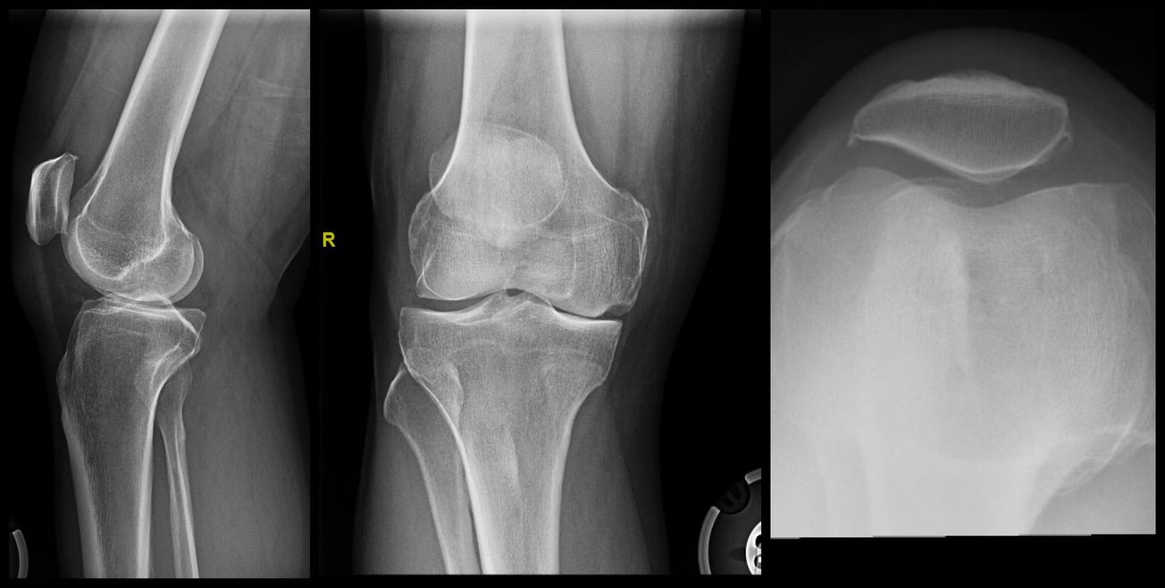 Unicompartmental Knee Arthroplasty