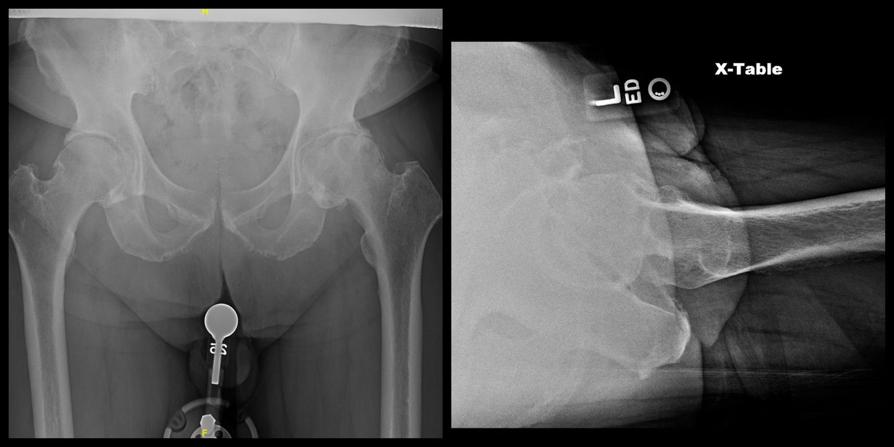 Total Hip Arthroplasty (Posterior)