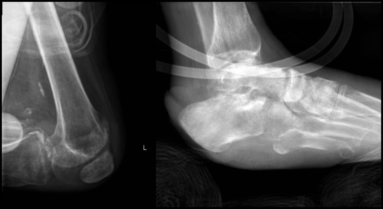 Above Knee Amputation