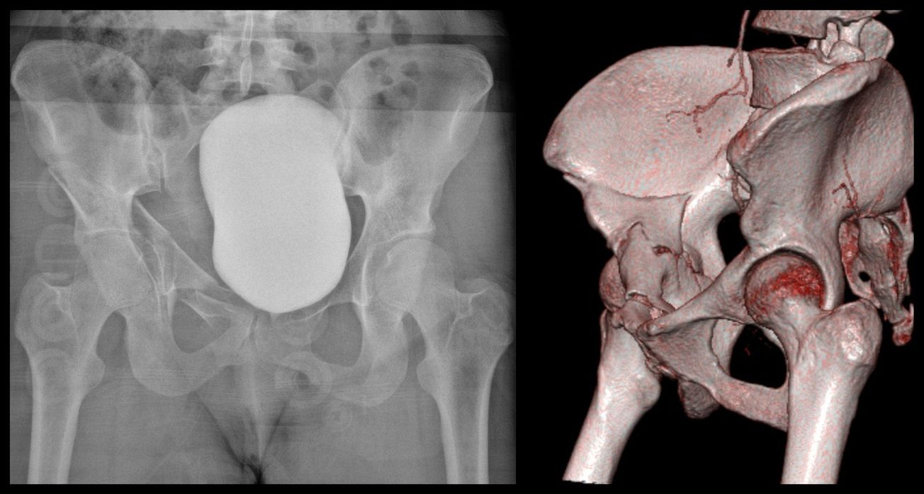 Anterior Column Acetabulum ORIF