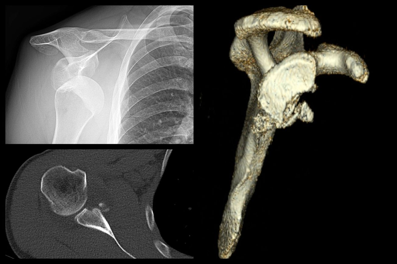 Glenoid Reconstruction with Allograft