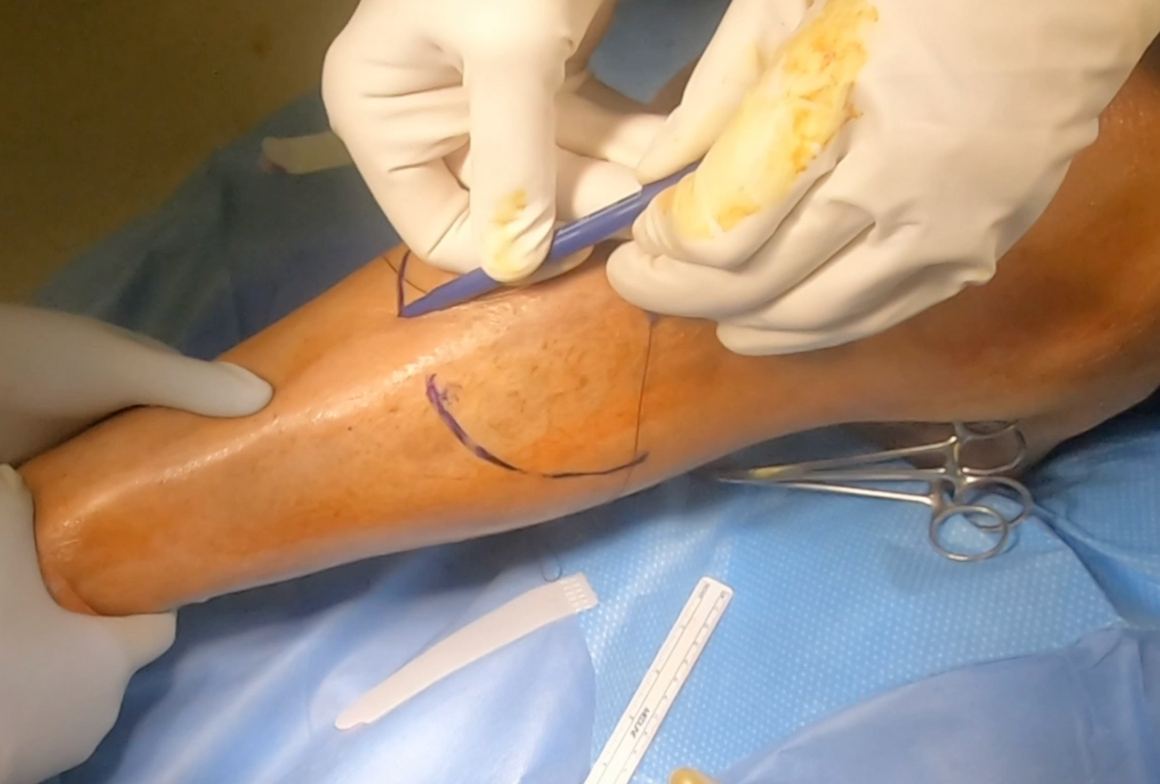 Below Knee Amputation