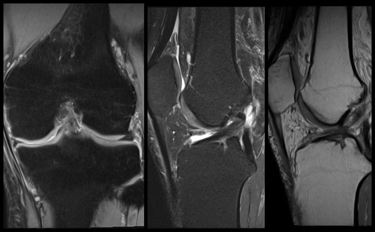 ACL Reconstruction (BTB autograft)