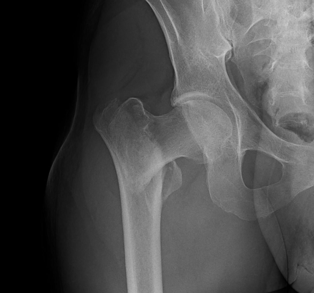 Intertrochanteric Fracture Short Nail