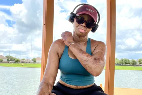 A Black burn survivor in exercise clothes. She wears sunglasses, a maroon Hersey's baseball cap, and black earphones.