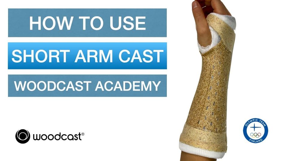 Circumferential Arm Cast with Woodcast