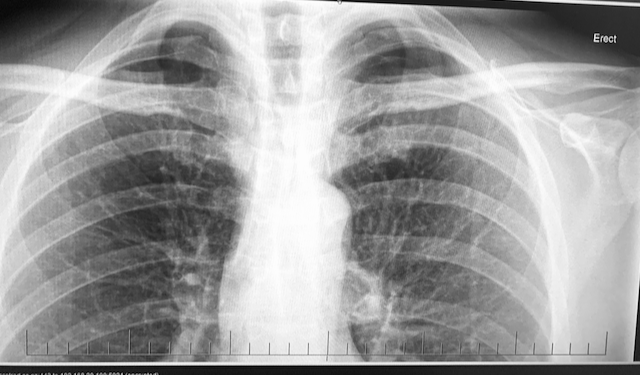 Pneumothorax