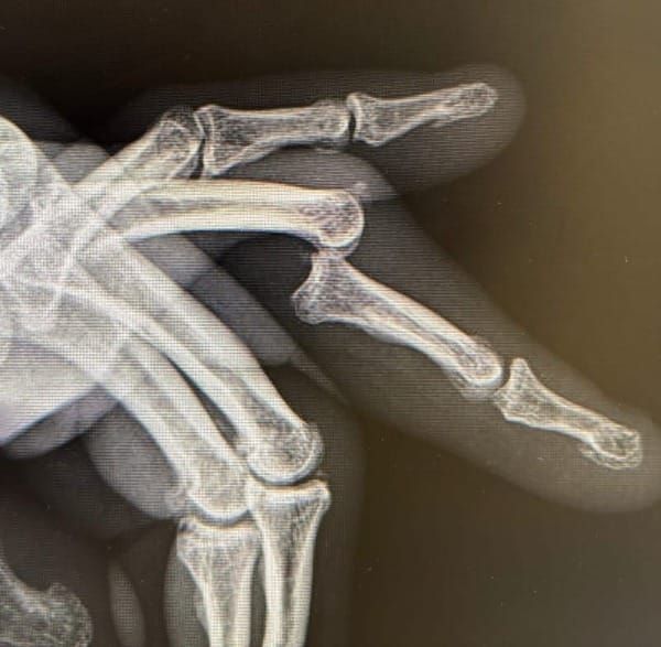 Volar PIPJ dislocation