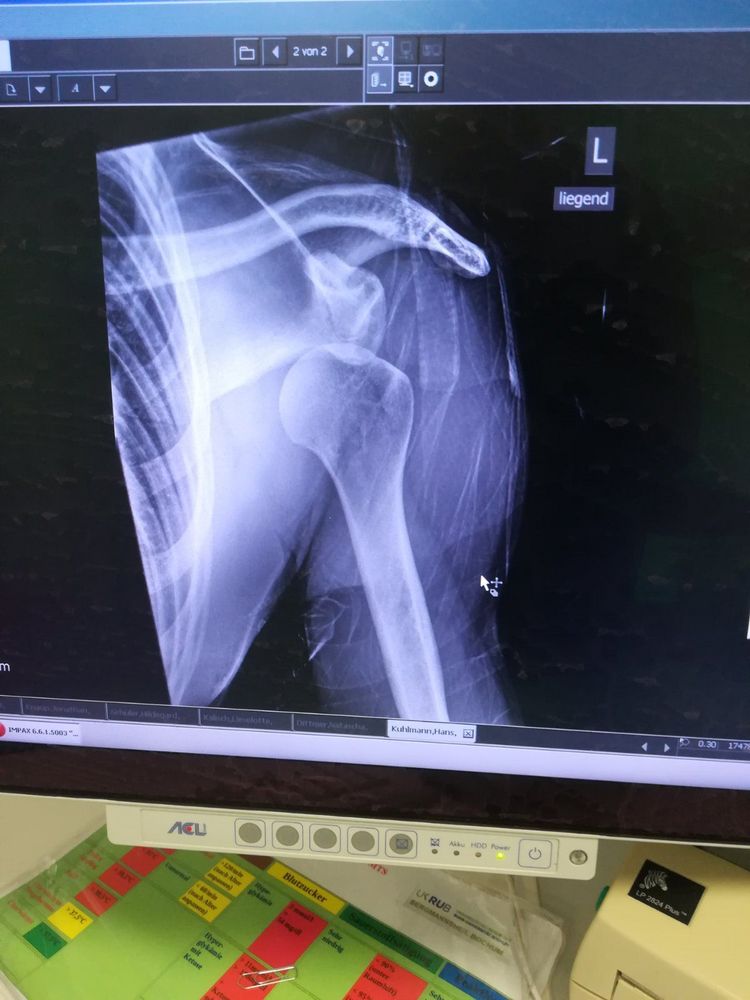 My Shoulder Dislocation & useful links and information on recovery 🦾