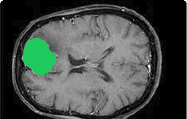 Brain Semantic Segmentation for Brain Tumors Screening with Computer Vision