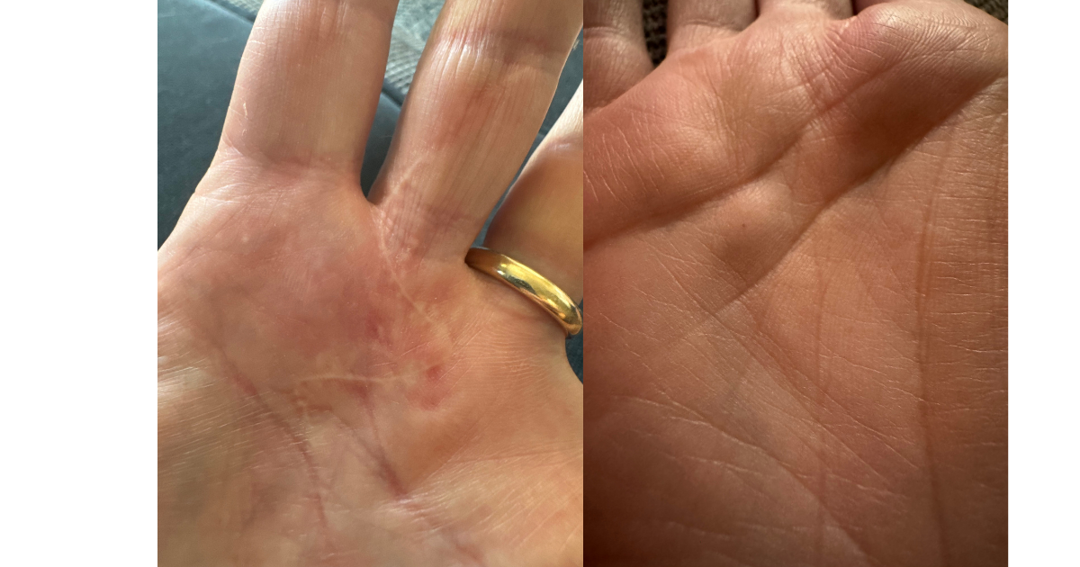 two photos of a palm; the left one shows a zig zag scar, the right a small bump