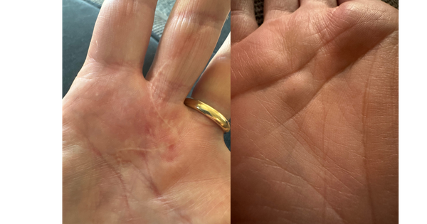 two photos of a palm; the left one shows a zig zag scar, the right a small bump