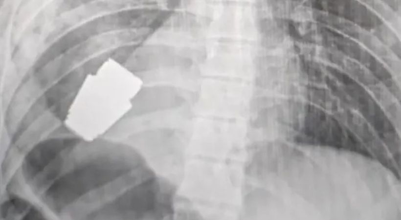 ഹൃദയത്തിന് തൊട്ടുതാഴെ ഗ്രനേഡ്; സര്‍ജറിയിലൂടെ യുക്രൈന്‍ സൈനികന്‍ അത്ഭുതകരമായി രക്ഷപെട്ടു