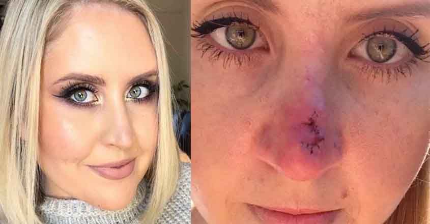 മുഖ കുരുവാണെന്ന്  കരുതി  കുത്തി പൊട്ടിച്ചു; പരിശോധിച്ചപ്പോൾ മാരകകാൻസർ