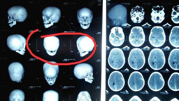 പ്രതീക്ഷകൾക്ക്  വിട; തൊടുപുഴയില്‍ മര്‍ദനമേറ്റ കുട്ടിക്ക് മസ്തിഷ്‌ക മരണം സംഭവിച്ചതായി ഡോക്ടർമാരുടെ റിപ്പോർട്ട്