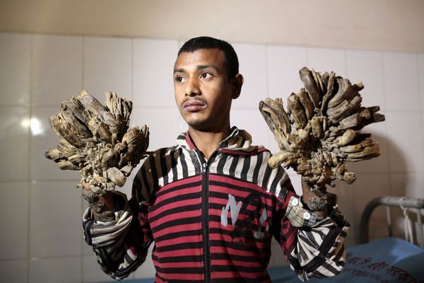 അബുൾ ബജന്ദാർ ഇനി വൃക്ഷ മനുഷ്യൻ അല്ല