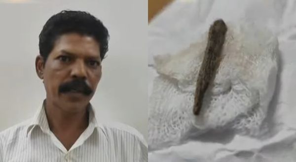 ചേലക്കര താലൂക്ക് ആശുപത്രിയില്‍ ചികിത്സാപ്പിഴവ്; തുന്നിക്കെട്ടിയ മുറിവില്‍ നിന്ന് 5 മാസത്തിന് ശേഷം മരച്ചീള് കണ്ടെത്തി