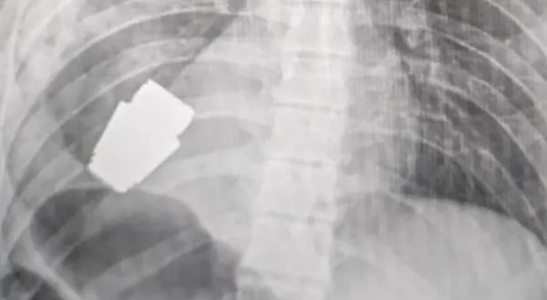 ഹൃദയത്തിന് തൊട്ടുതാഴെ ഗ്രനേഡ്; സര്‍ജറിയിലൂടെ യുക്രൈന്‍ സൈനികന്‍ അത്ഭുതകരമായി രക്ഷപെട്ടു