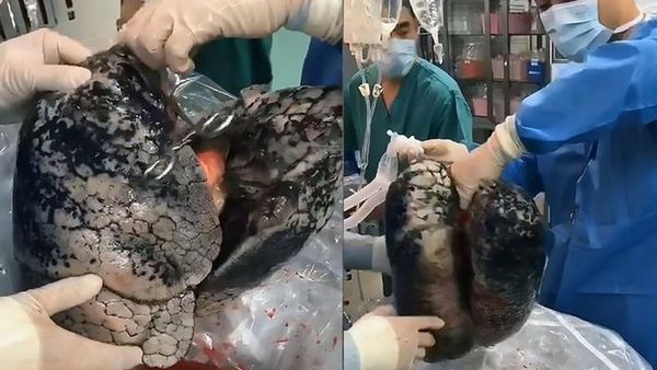 ഈ ശ്വാസകോശം സ്‌പോഞ്ച് പോലെയല്ല; പുകവലിക്ക് അടിമയായി മരിച്ചയാളുടെ ശ്വാസകോശത്തിന്റെ ഞെട്ടിക്കുന്ന ദൃശ്യങ്ങള്‍