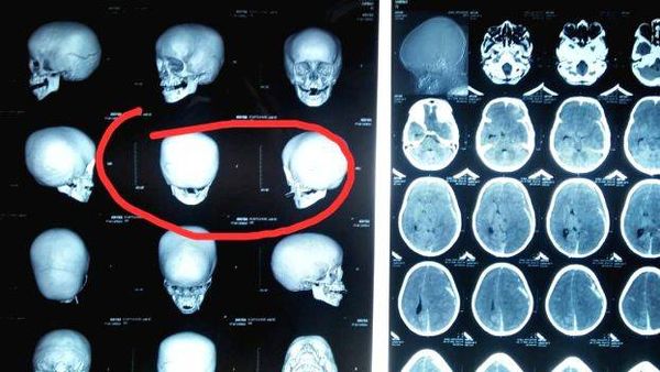 പ്രതീക്ഷകൾക്ക്  വിട; തൊടുപുഴയില്‍ മര്‍ദനമേറ്റ കുട്ടിക്ക് മസ്തിഷ്‌ക മരണം സംഭവിച്ചതായി ഡോക്ടർമാരുടെ റിപ്പോർട്ട്