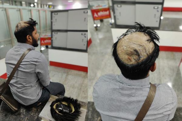 തലയിലൊളിപ്പിച്ച്  25 ലക്ഷത്തിന്റെ സ്വര്‍ണം കടത്താൻ  ശ്രമം;  കരിപ്പൂർ വിമാനത്താവളത്തിൽ പിടിയിലായി യുവാവ്