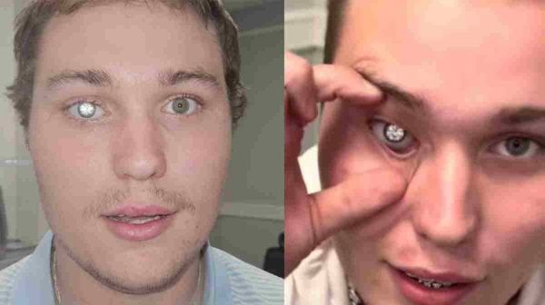 കാഴ്ച പോയി, കണ്ണില്‍ രണ്ട് കാരറ്റ് വജ്രം പതിപ്പിച്ച് ആഭരണക്കടയുടമ; ചെലവ് 16കോടി